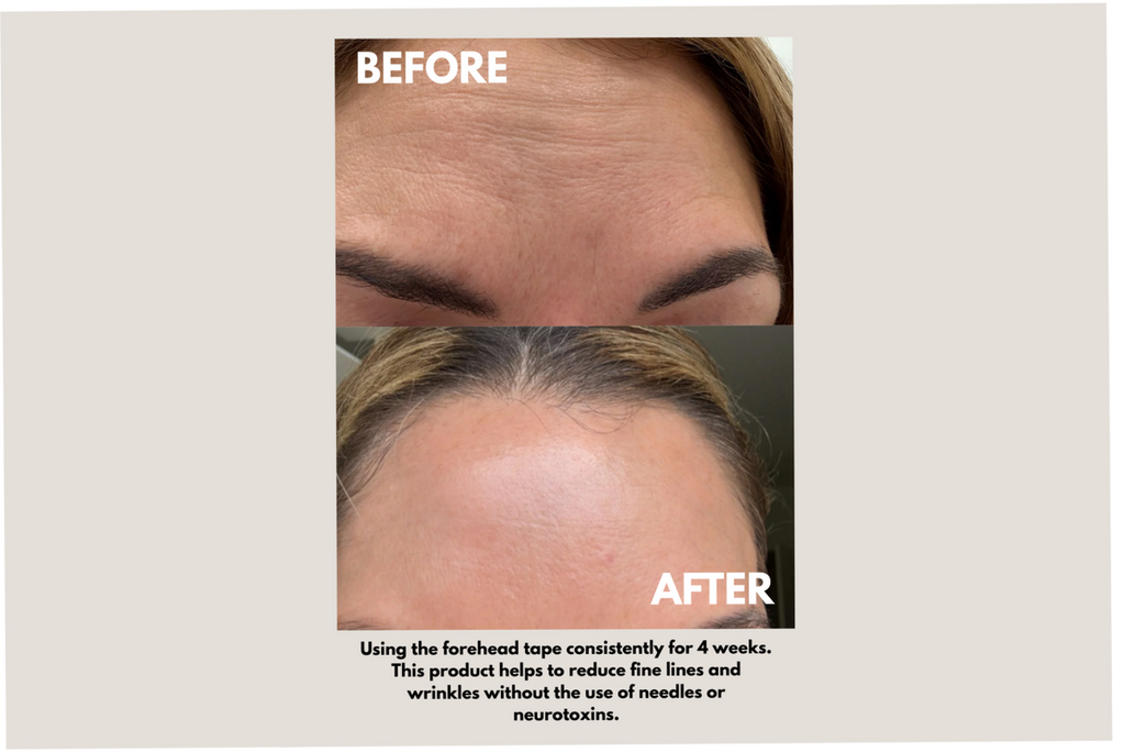 Forehead Tape – Wrinkle Smoothing Patches | Seald™ Wellness
