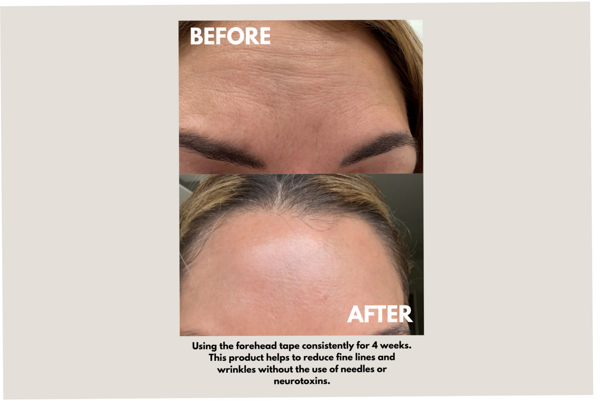 Forehead Tape – Wrinkle Smoothing Patches | Seald™ Wellness