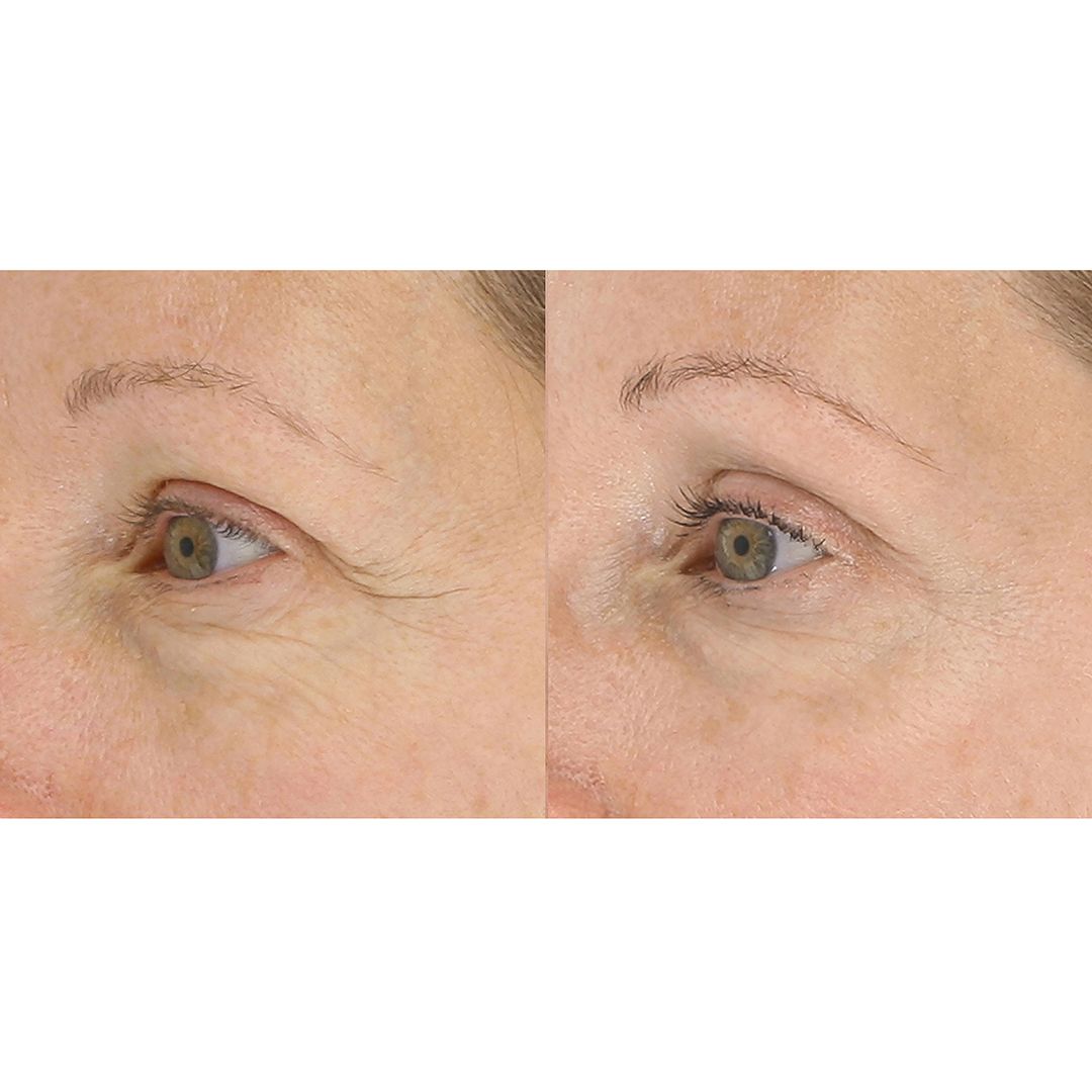 LightStim For Wrinkles | LightStim