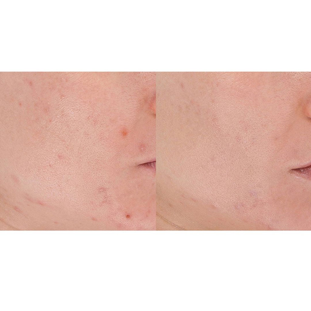 LightStim for Acne | LightStim