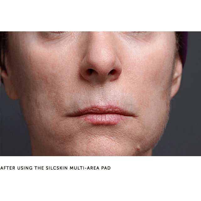 SilcSkin Multi-Area Facial Pads