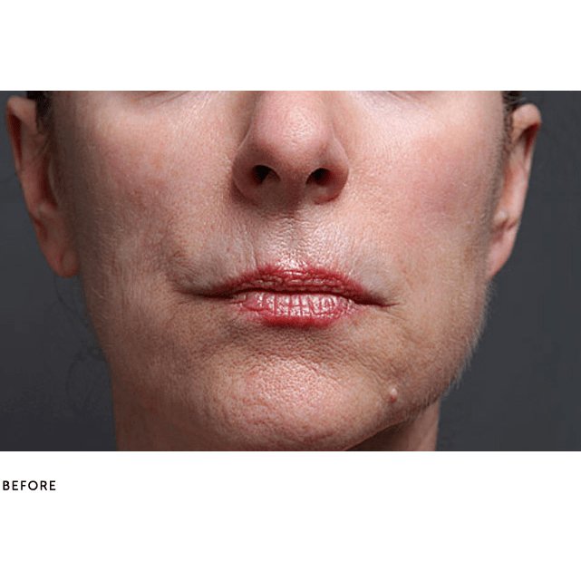 SilcSkin Multi-Area Facial Pads